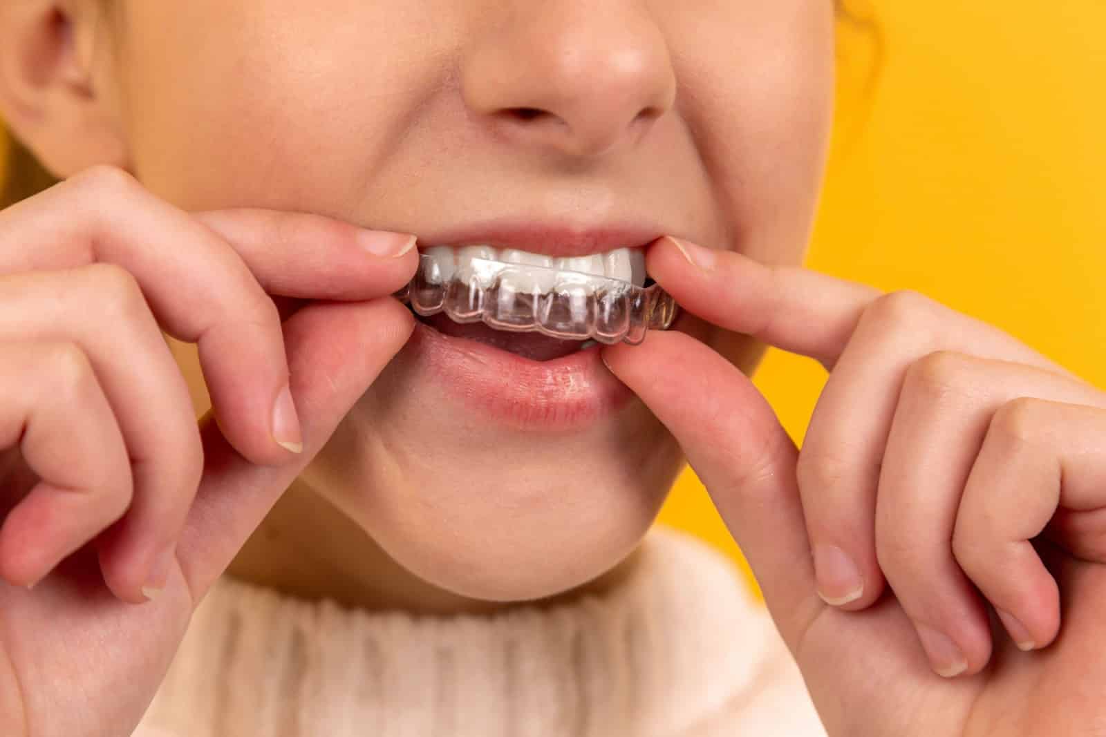 Splints for TMJ Disorders: Relieving Jaw Pain and Tension