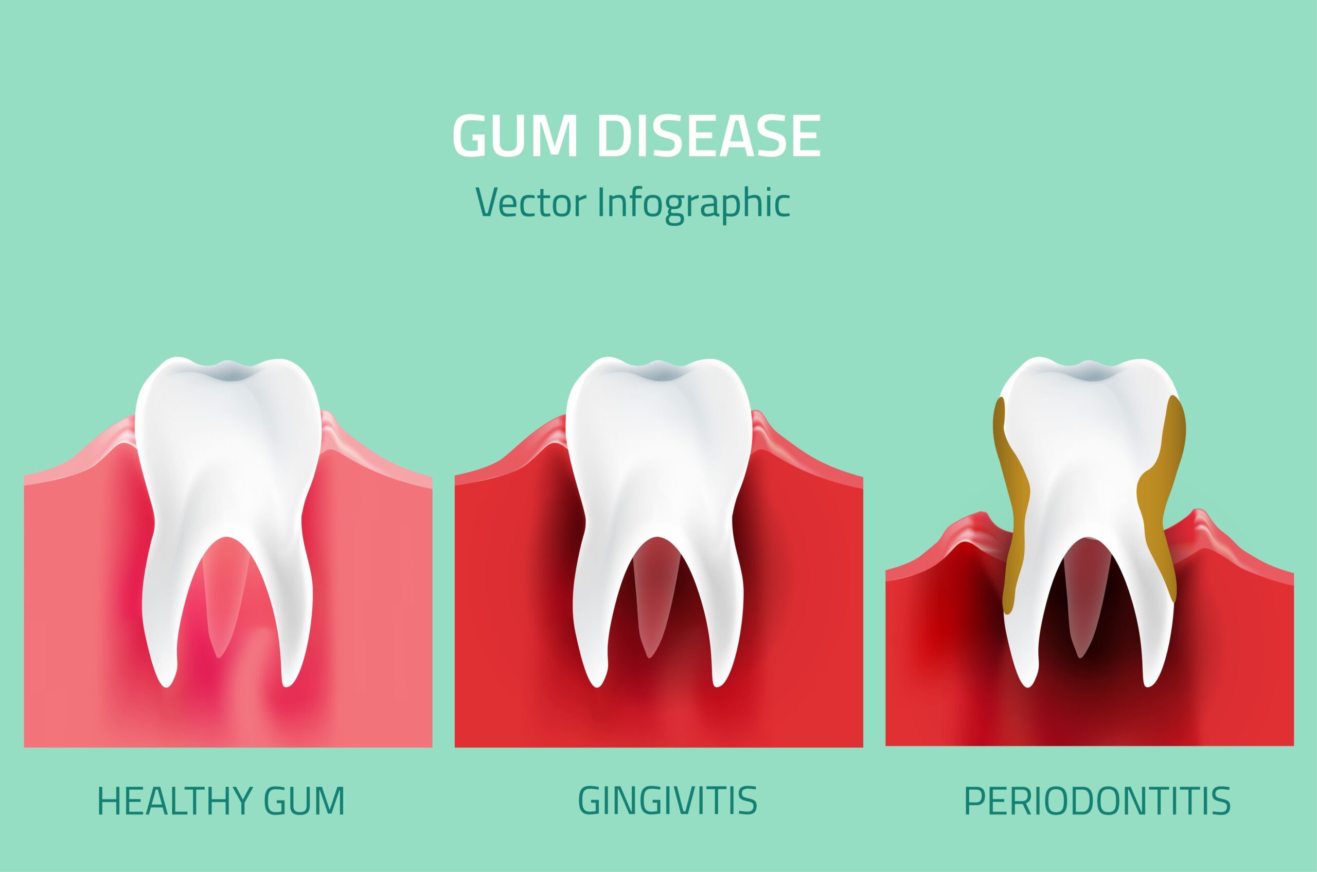Understanding the Stages of Gum Disease and How to Prevent It