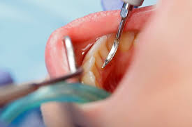 Scaling and Root Planing: What to Expect